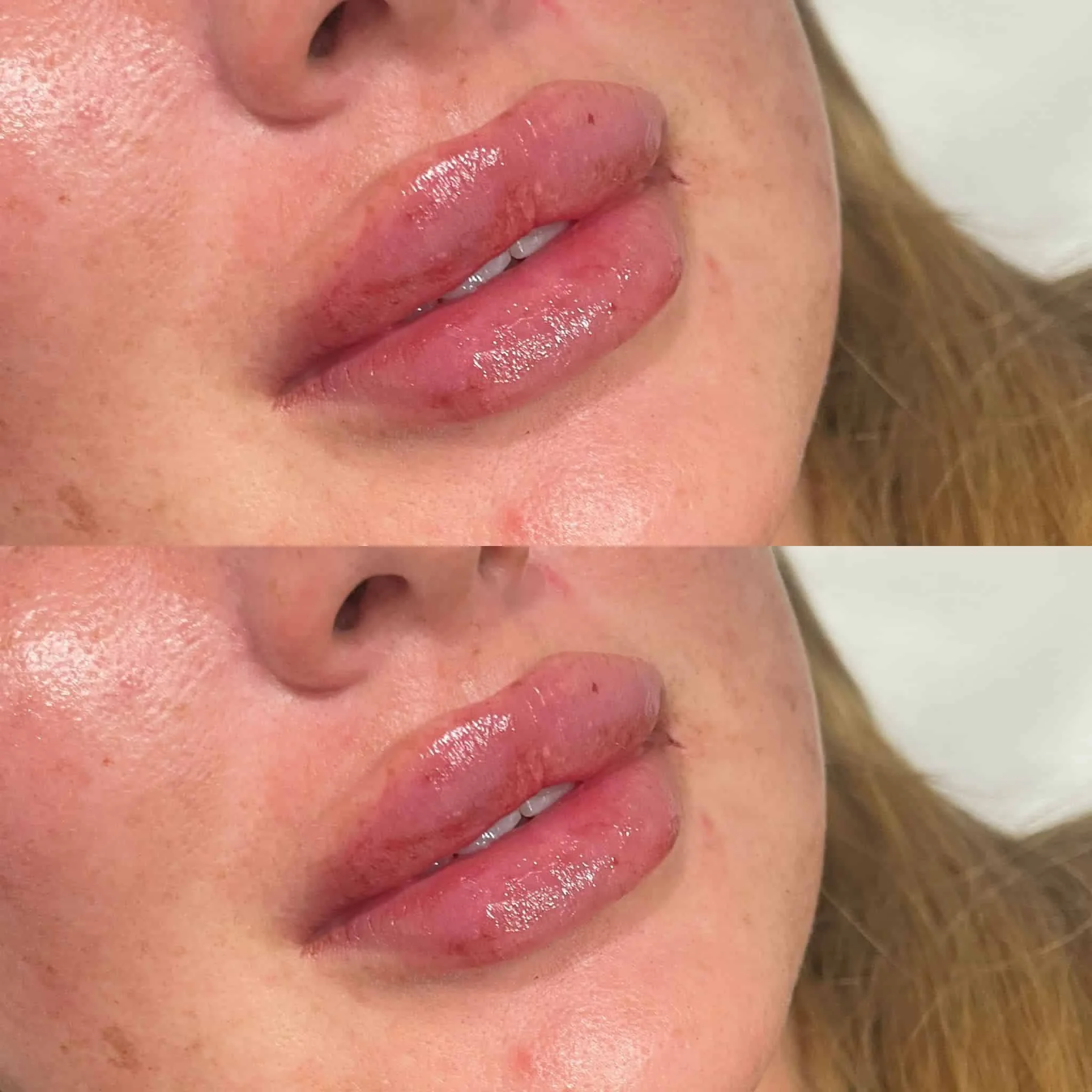 lip-fillers-4.webp