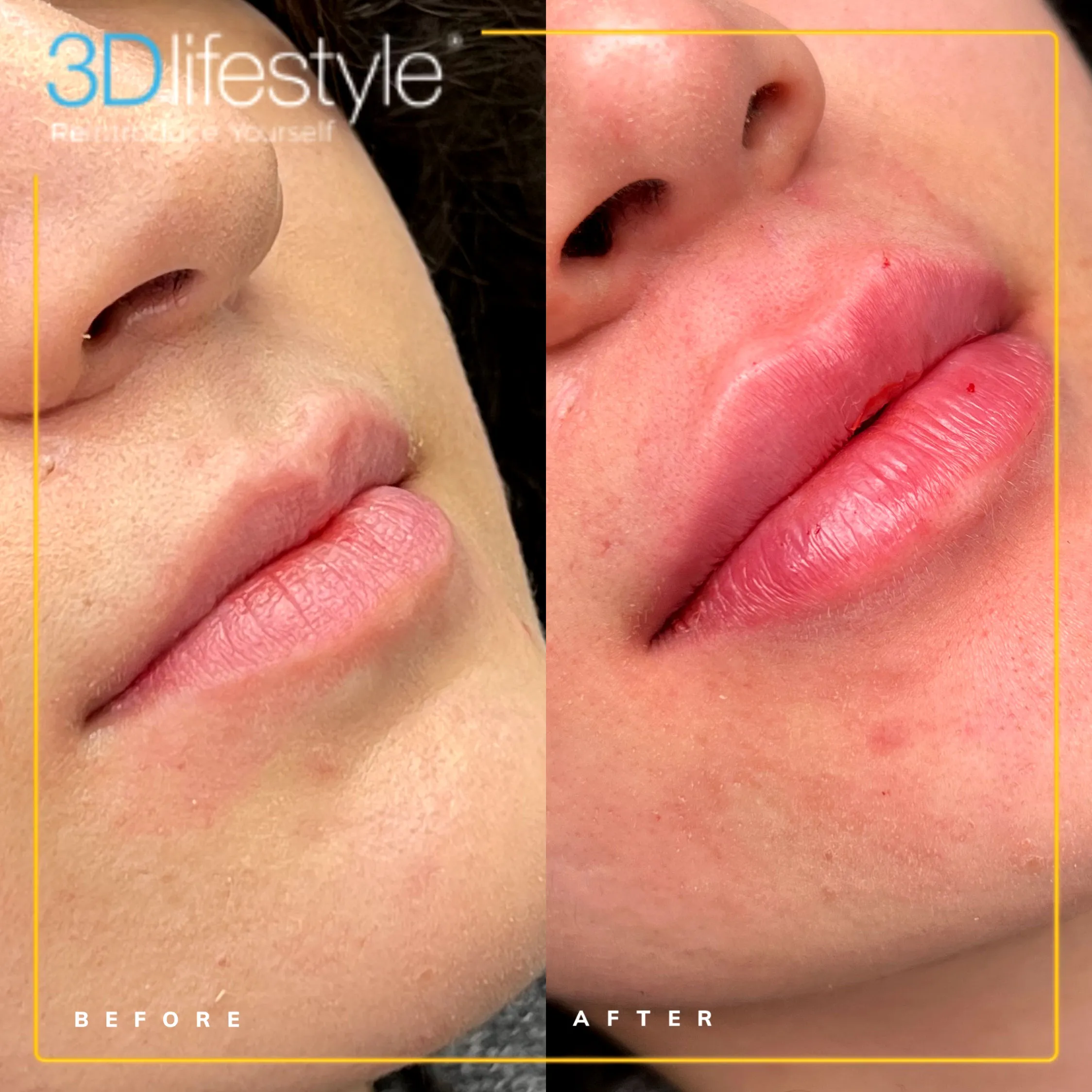 Before-after-Lip-Fillers.webp