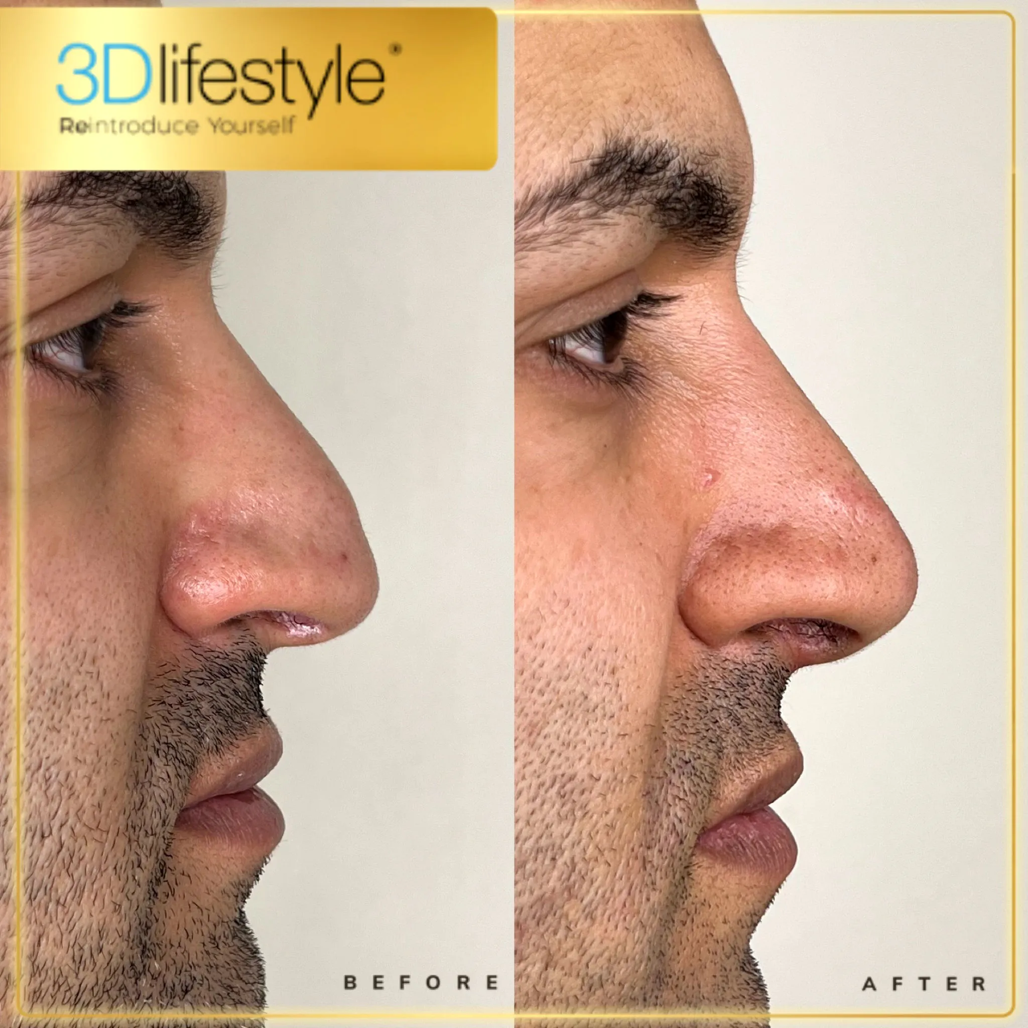 Before_After-Liquid-Rhinoplasty.webp