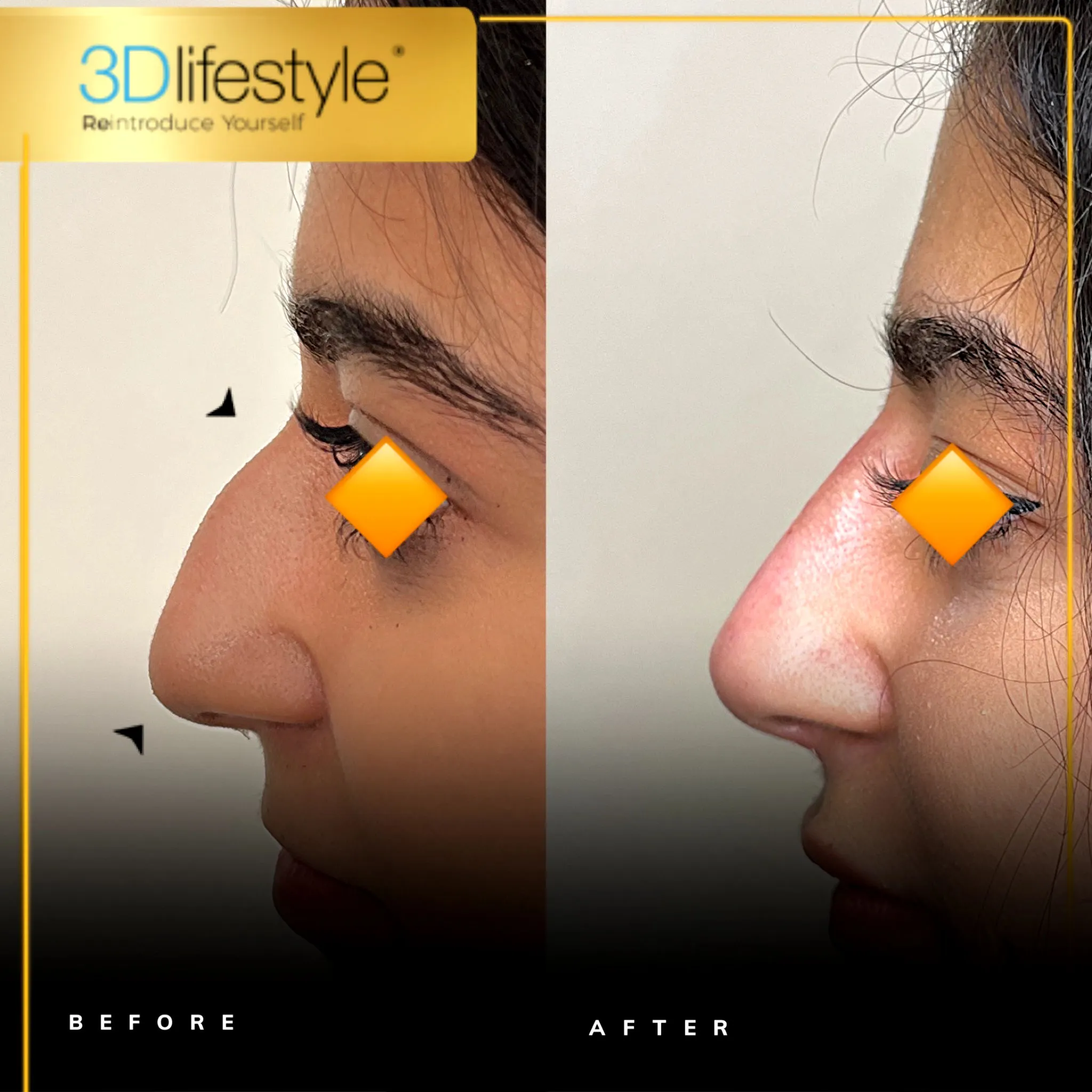 Before_after-Liquid-Rhinoplasty1.webp