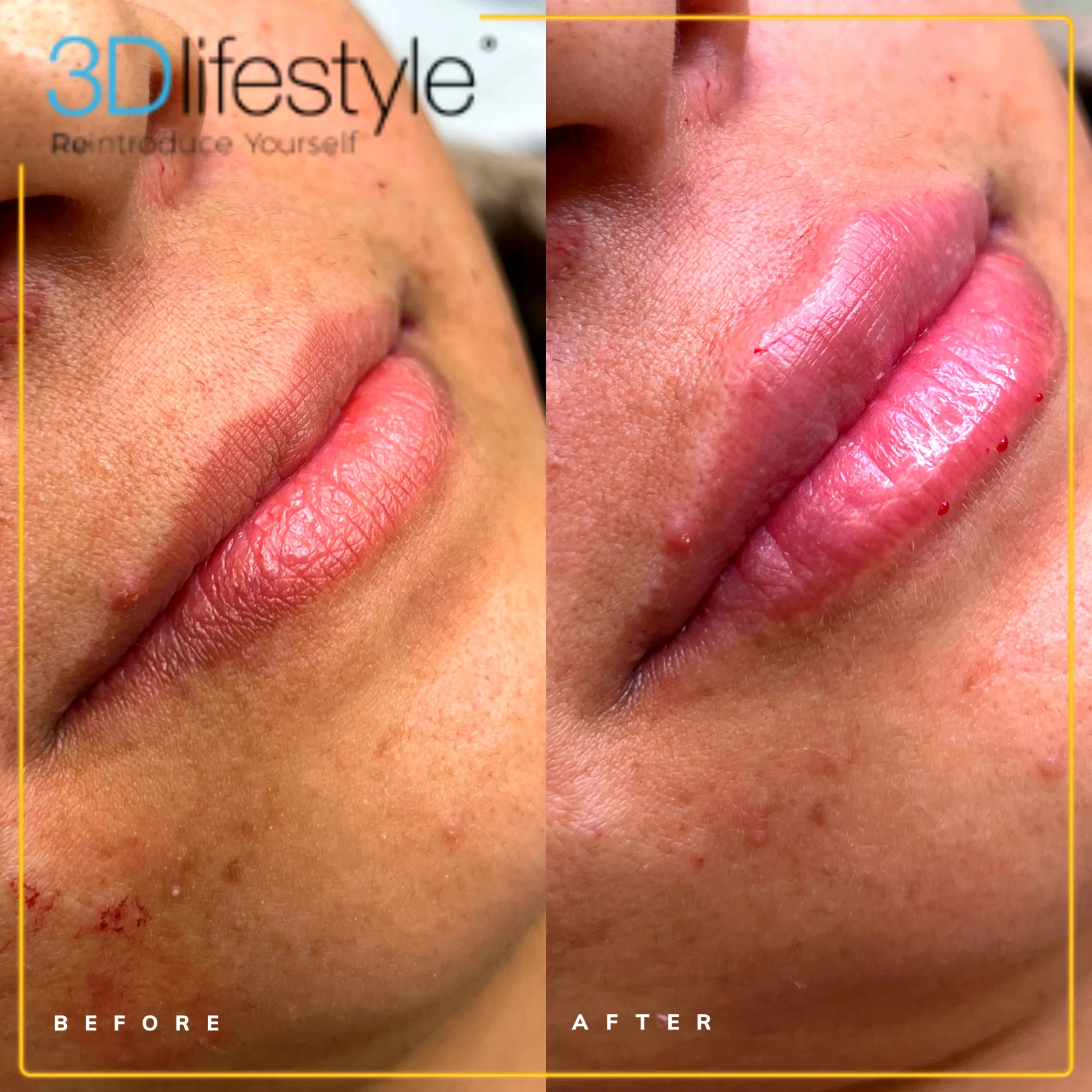 Lip-Filler-Before-after.webp